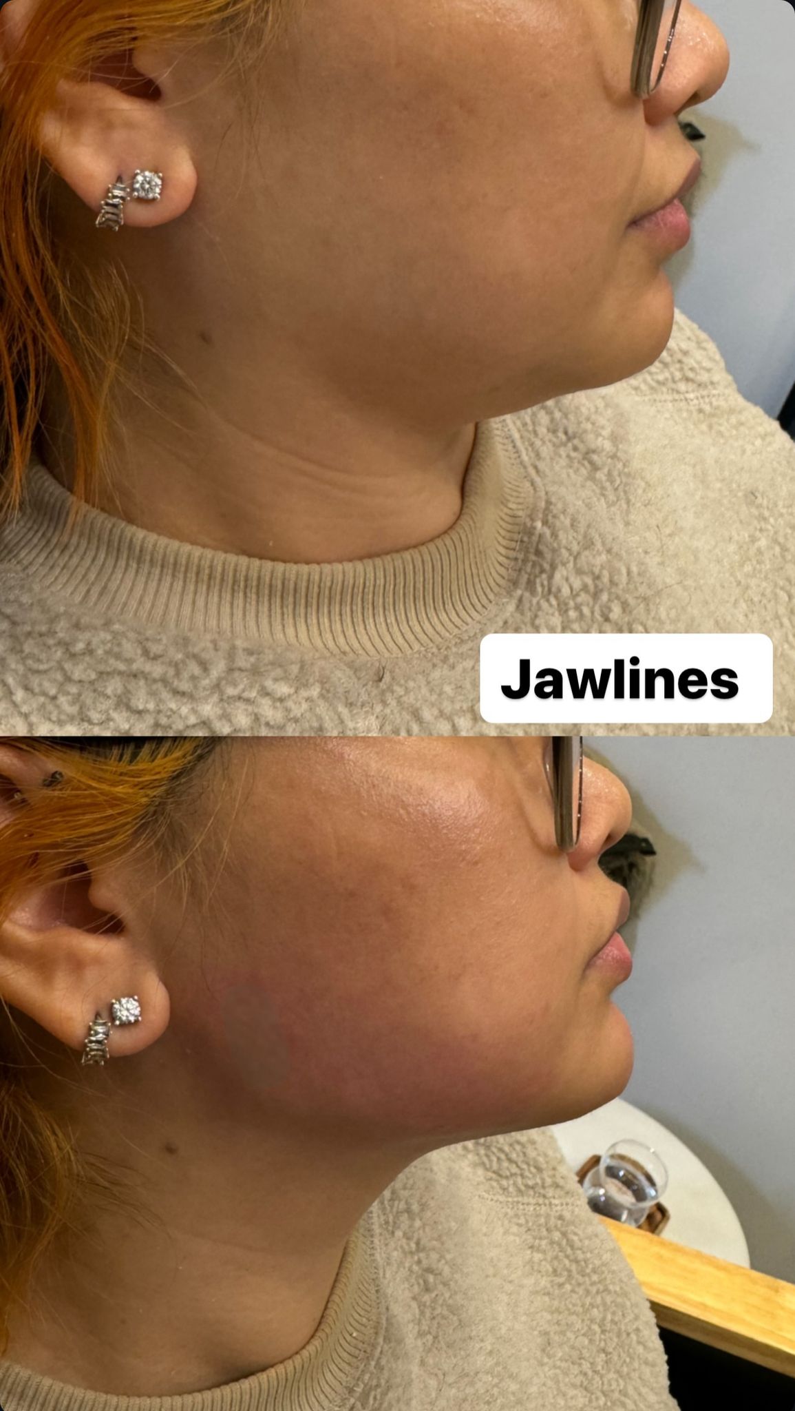 Facial Slimming mit Jawline