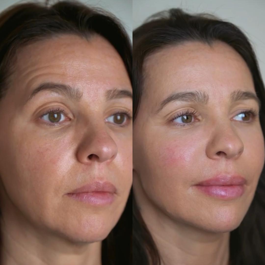 Liquid Facelift 3
